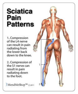 Sciatica